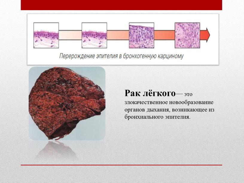 Рак лёгкого— это злокачественное новообразование органов дыхания, возникающее из бронхиального эпителия