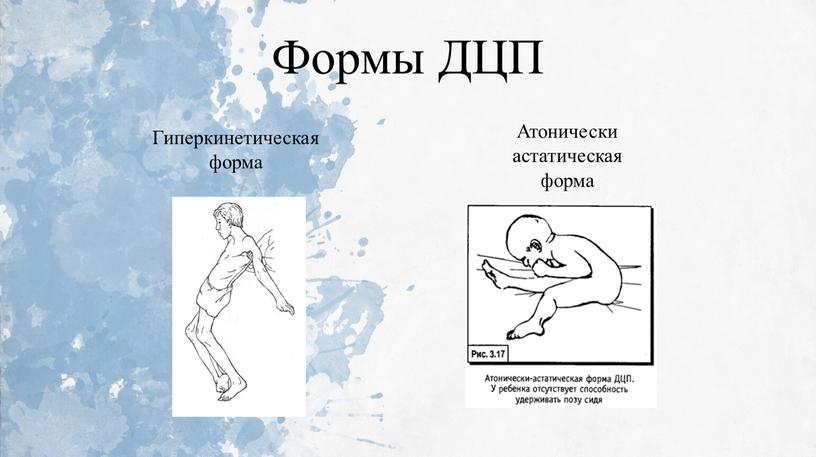 Формы ДЦП Гиперкинетическая форма