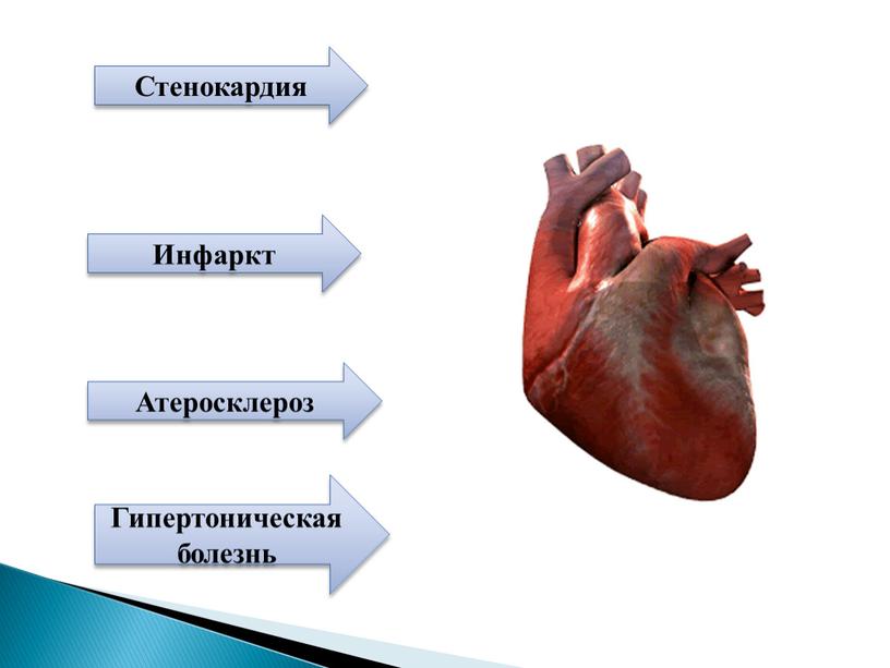 Стенокардия Инфаркт Атеросклероз