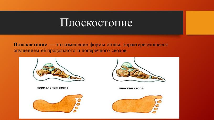 Плоскостопие Плоскостопие — это изменение формы стопы, характеризующееся опущением её продольного и поперечного сводов