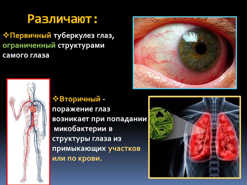 Различают: Первичный туберкулез глаз, ограниченный структурами самого глаза