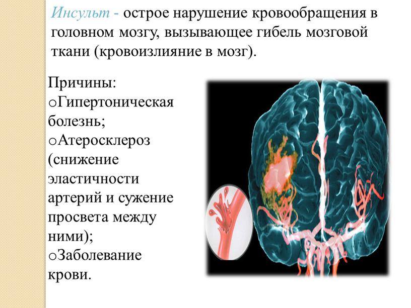 Инсульт - острое нарушение кровообращения в головном мозгу, вызывающее гибель мозговой ткани (кровоизлияние в мозг)