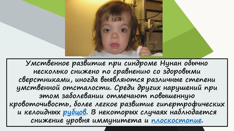 Умственное развитие при синдроме