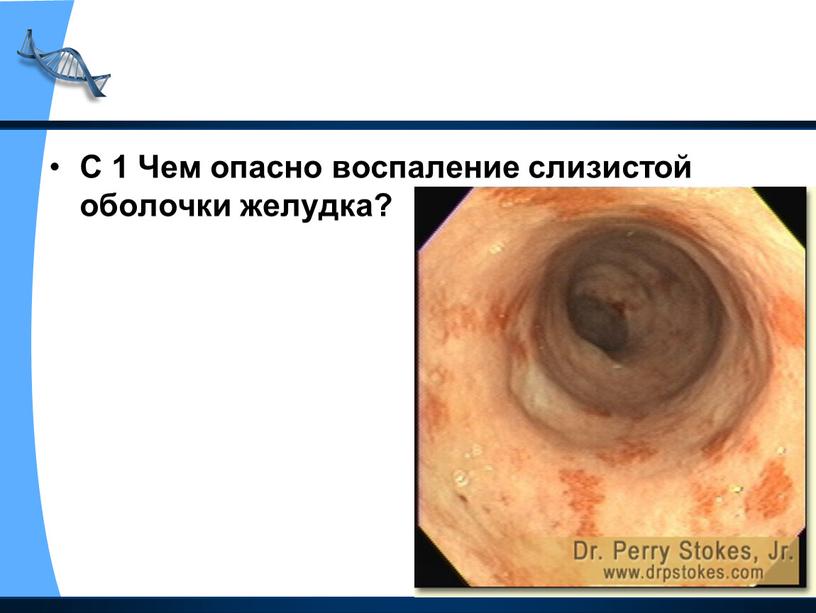 С 1 Чем опасно воспаление слизистой оболочки желудка?