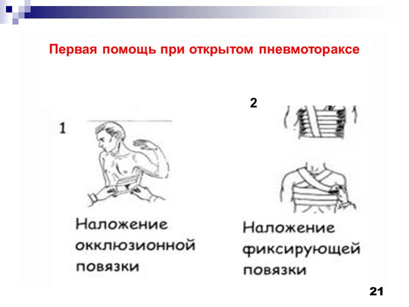 Первая помощь при открытом пневмотораксе 2