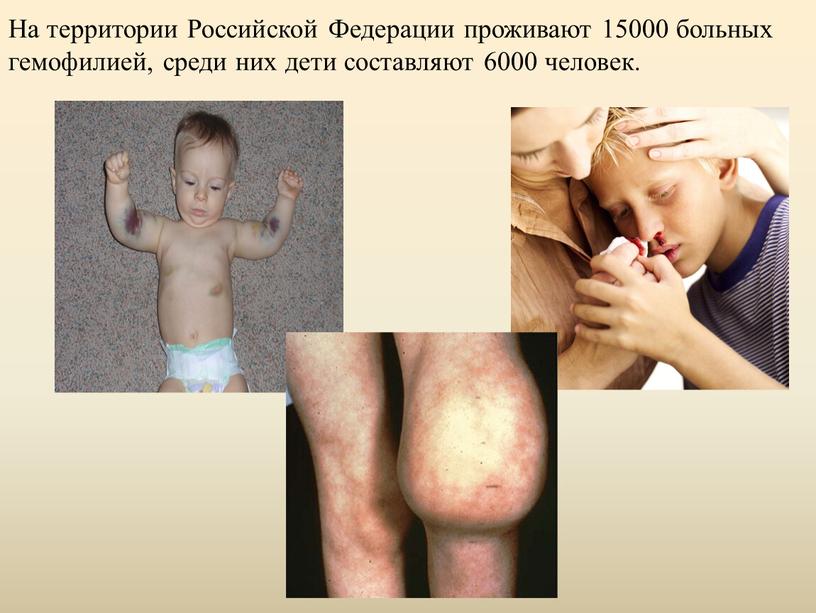 На территории Российской Федерации проживают 15000 больных гемофилией, среди них дети составляют 6000 человек