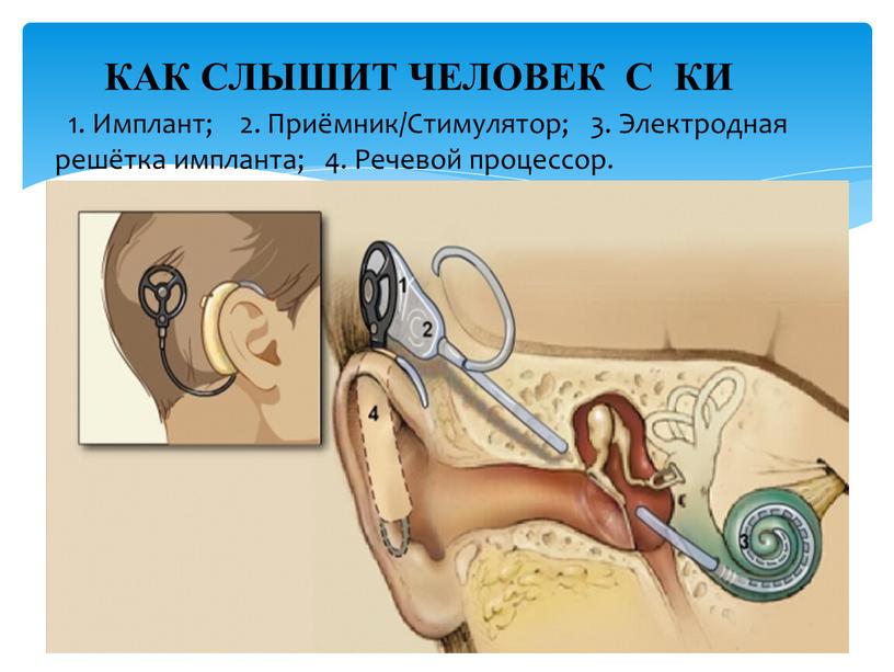 Имплант; 2. Приёмник/Стимулятор; 3