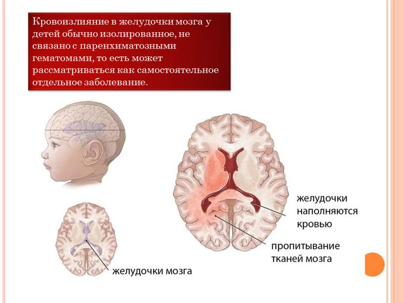 Кровоизлияние в желудочки мозга у детей обычно изолированное, не связано с паренхиматозными гематомами, то есть может рассматриваться как самостоятельное отдельное заболевание