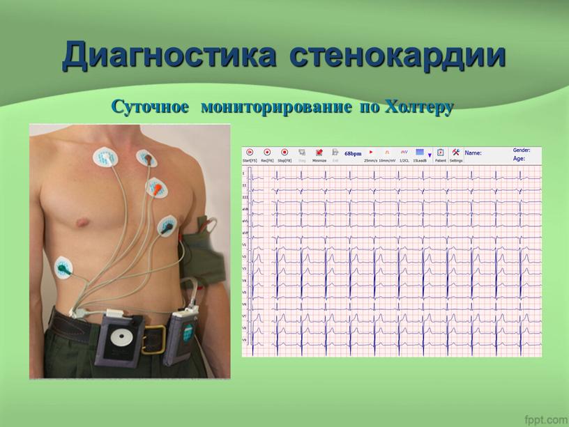 Диагностика стенокардии Суточное мониторирование по