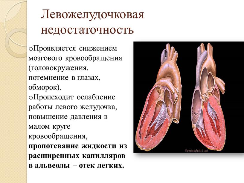 Левожелудочковая недостаточность