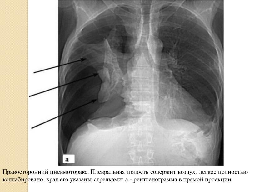 Правосторонний пневмоторакс. Плевральная полость содержит воздух, легкое полностью коллабировано, края его указаны стрелками: а - рентгенограмма в прямой проекции