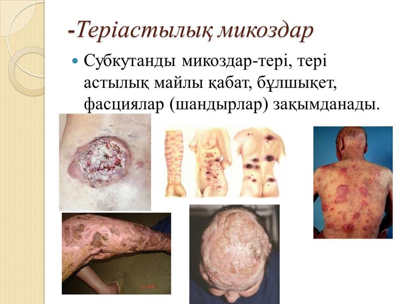 Теріастылық микоздар Субкутанды микоздар-тері, тері астылық майлы қабат, бұлшықет, фасциялар (шандырлар) зақымданады