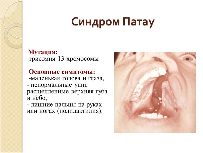 Синдром Патау Мутация: трисомия 13-хромосомы