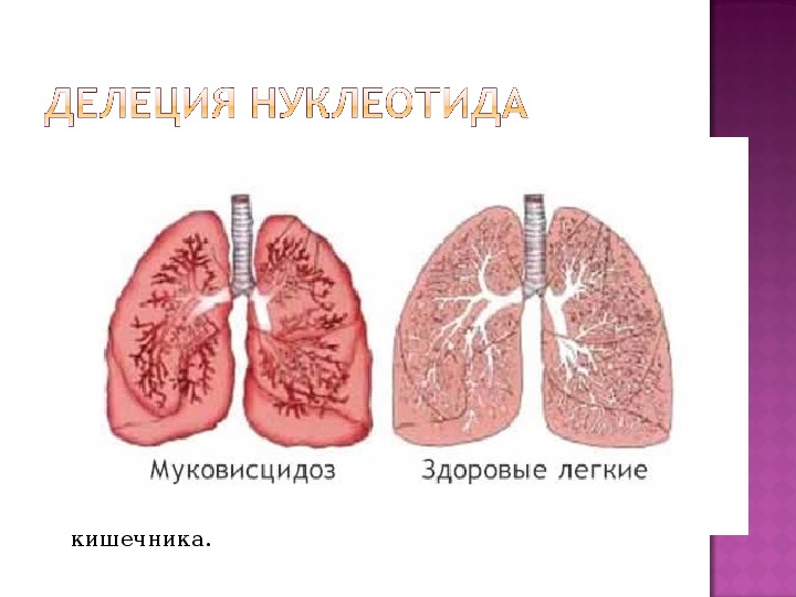 Муковисцидоз презентация генетика