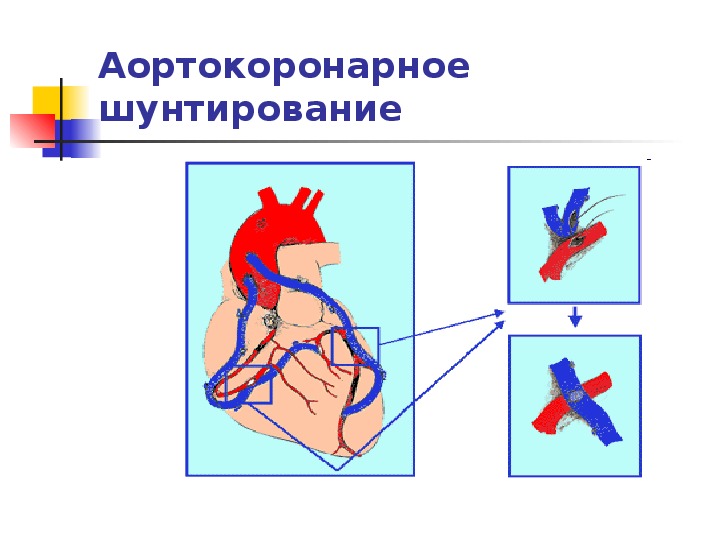 Схема аортокоронарного шунтирования