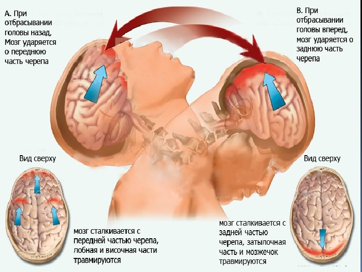 Царапина по сравнению с сотрясением мозга 6. Хлыстовая травма головы. Хлыстовая травма шейного отдела позвоночника при ДТП.