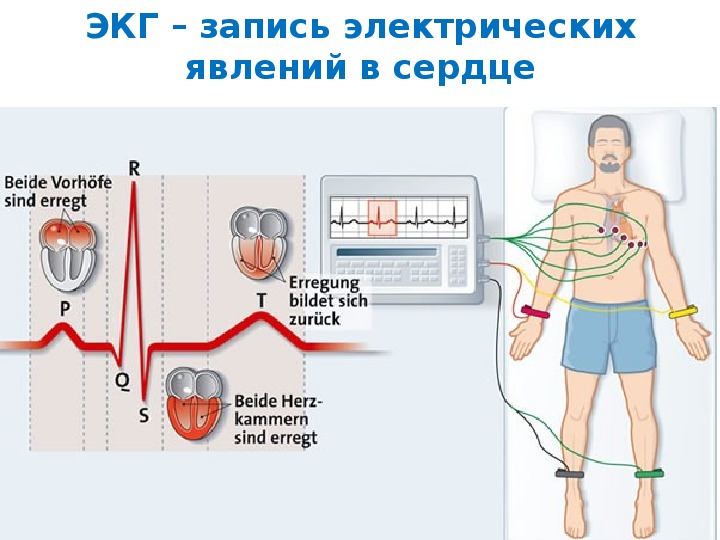 Экг картинка как накладывать