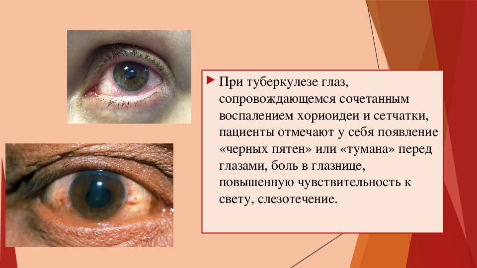 Клиника туберкулеза глаза