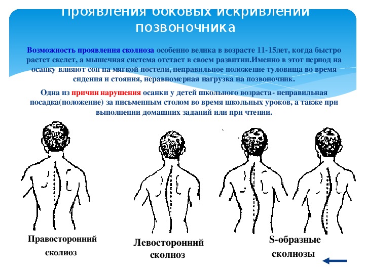 Боковое искривление позвоночника называется. Искривление позвоночника 15 лет.