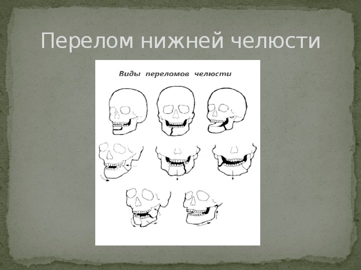 Методы закрепления отломков челюстей презентация члх