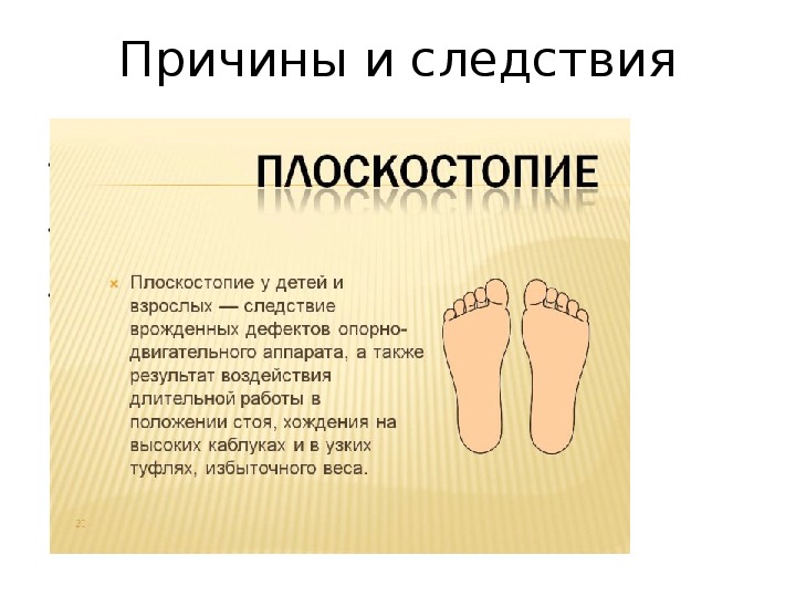 Что такое плоскостопие