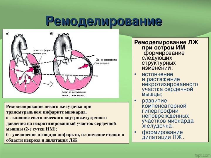 Миокарда левого желудочка. Ремоделирование сердца при инфаркте миокарда. Ремоделирование миокарда лж. Типы ремоделирования левого желудочка. Концентрическое ремоделирование миокарда левого желудочка.