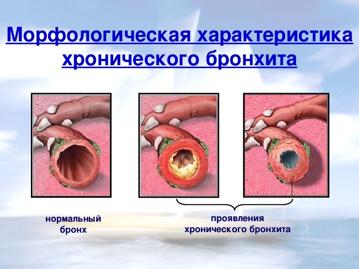 Образование отложений на стенках бронхов