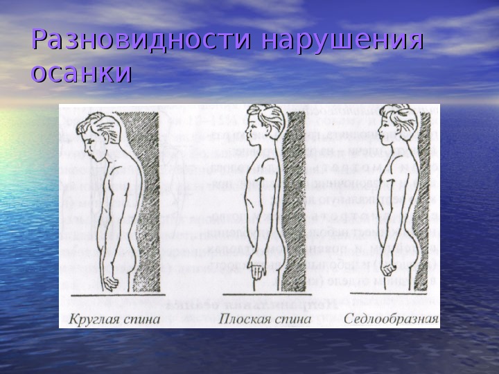 Мышцы влияющие на осанку. Виды нарушения осанки. Осанка скелет. На что влияет осанка. Какие мышцы влияют на осанку