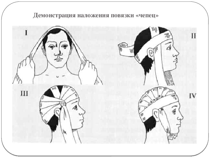 Перебинтовать голову схема