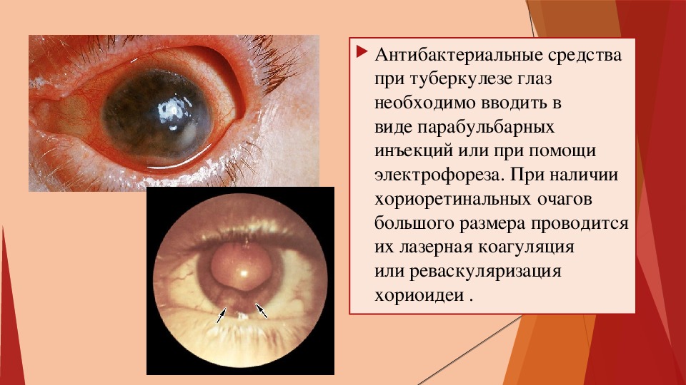 Туберкулез глаз презентация