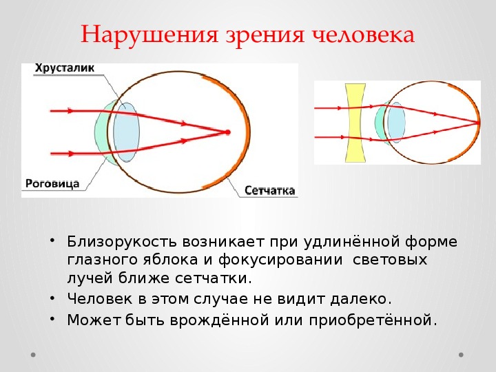 Презентация по биологии на тему близорукость и дальнозоркость