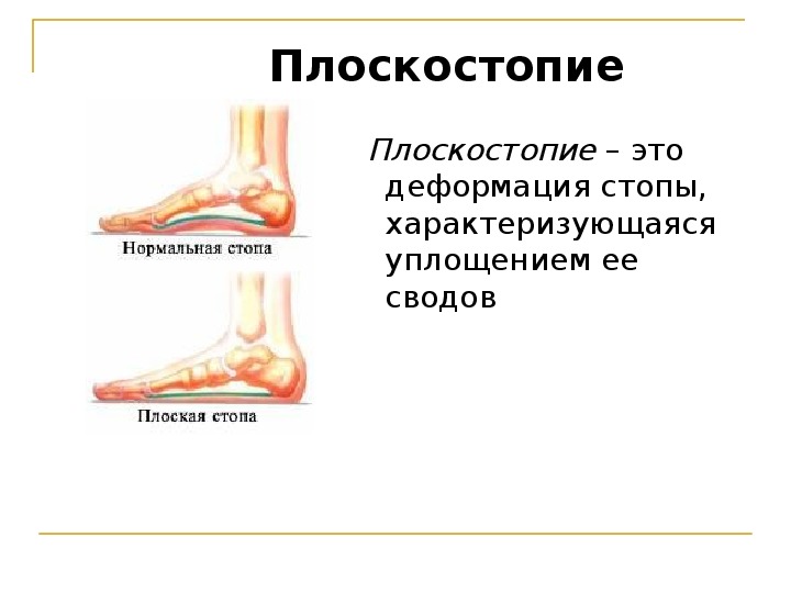 Презентация на тему плоскостопие