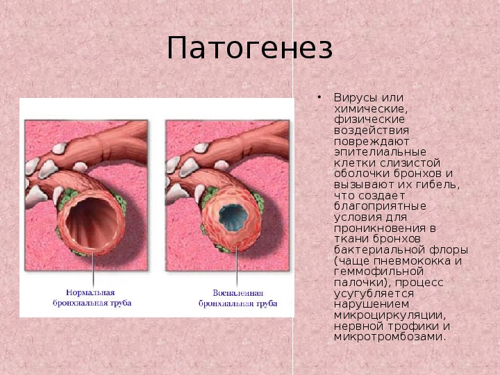 Хронический бронхит диаграммы