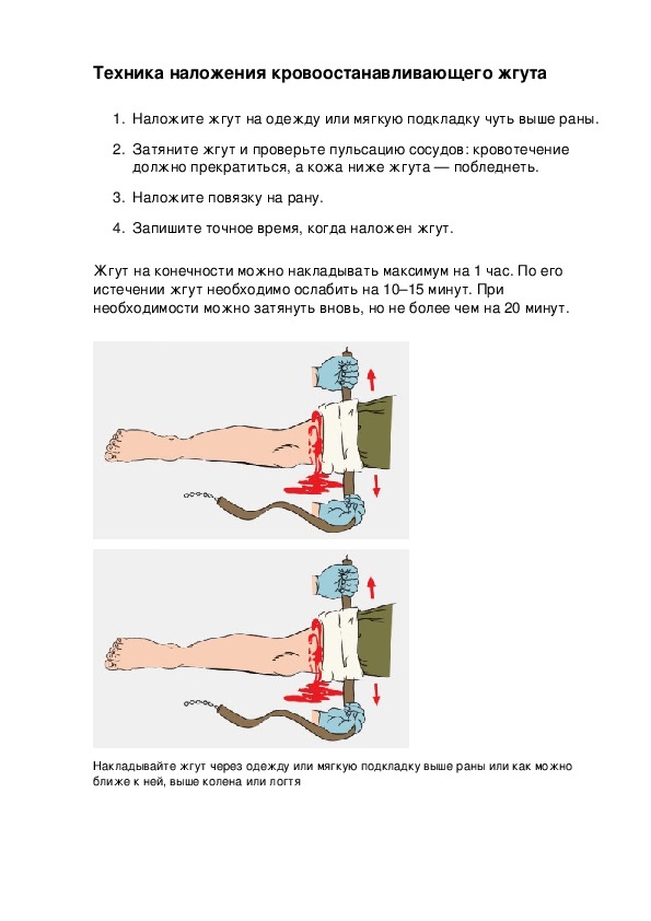 Наложение жгута при отеке легких. Техника наложения жгута. Особенности наложения жгута. Техника наложения жгута при отеке легких.