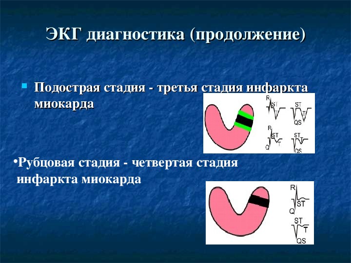 План ухода при инфаркте миокарда