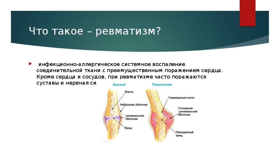 Презентация на тему ревматизм