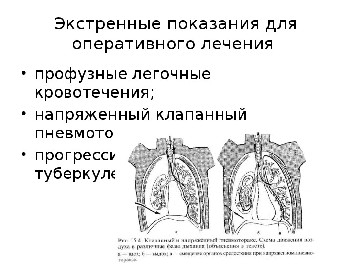 Спонтанный пневмоторакс презентация