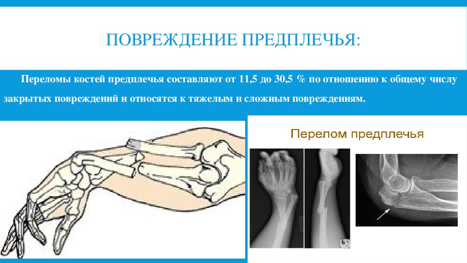 Перелом локтевой кости карта вызова скорой медицинской помощи