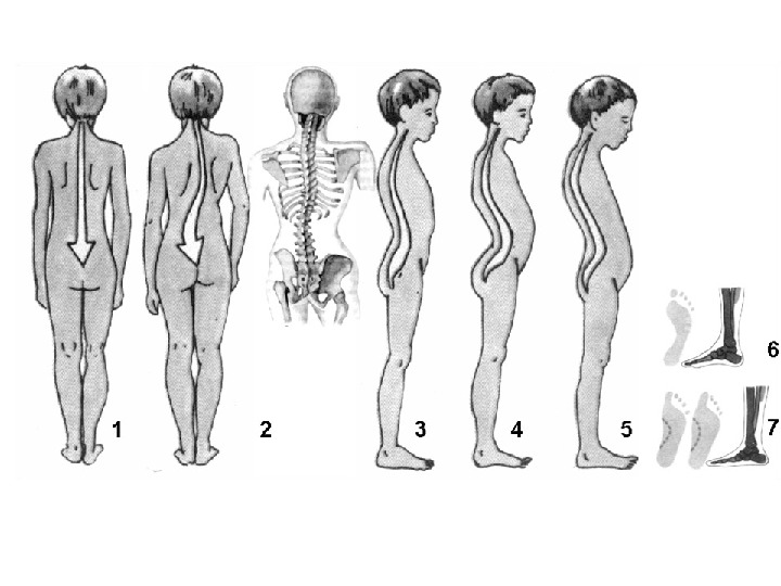 Сколиоз в картинках