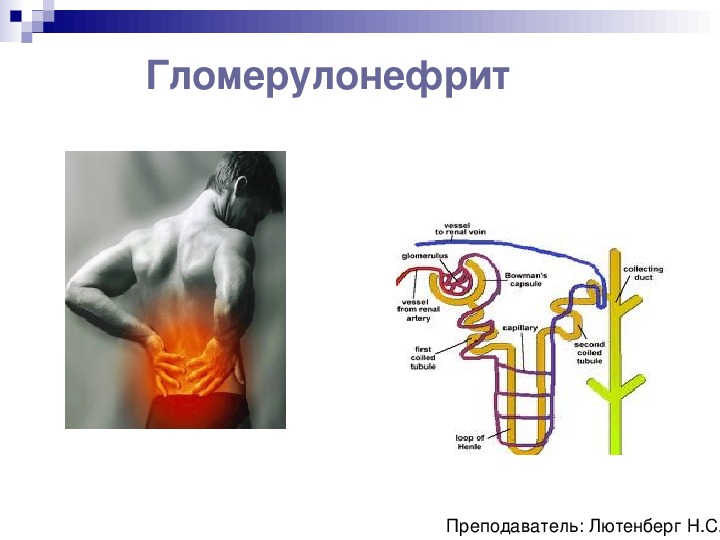 Гломерулонефрит хронический картинки