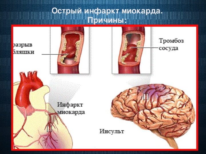 Инсульт сердца презентация