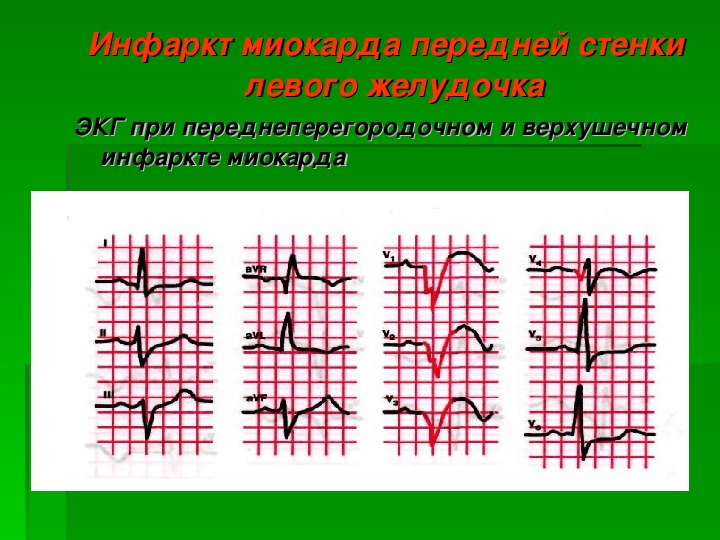 Пикс по передней стенке