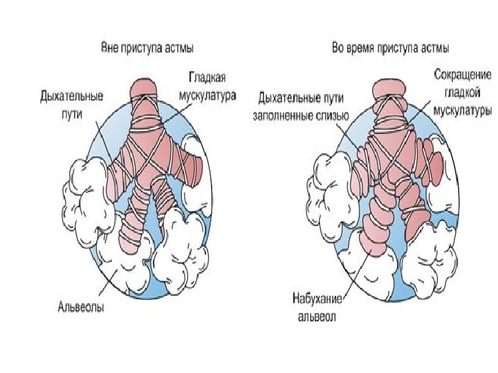 Бронхиальная астма схема