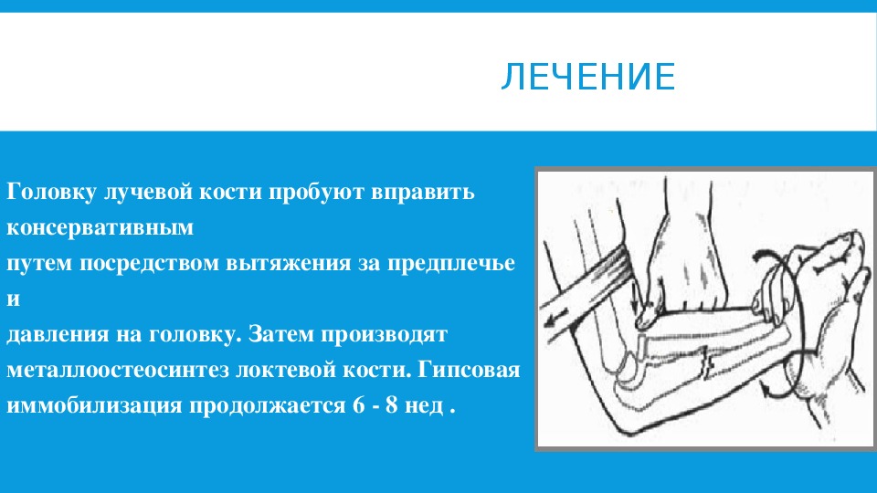 Головка лучевой кости. Подвывих головки лучевой кости вправление.