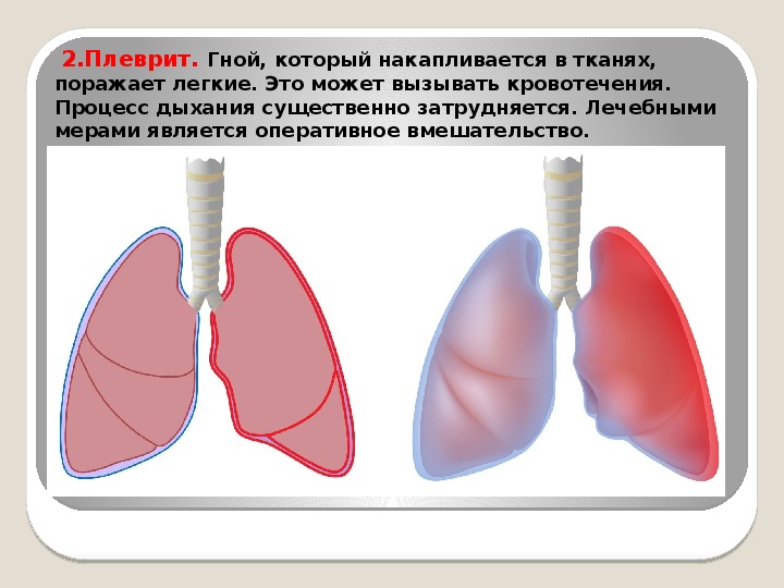 Экссудативный плеврит карта вызова