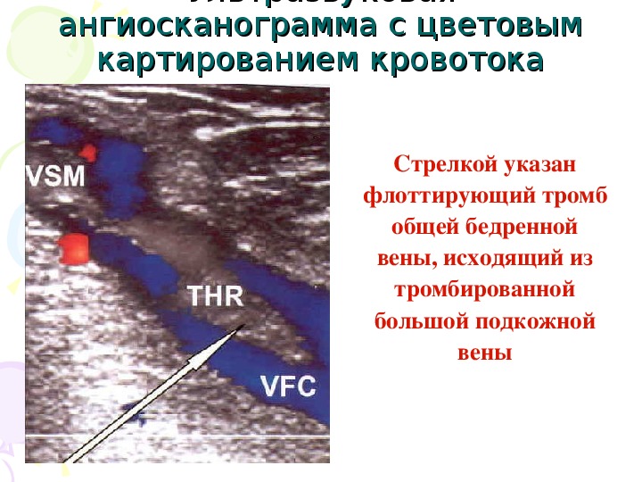 Венозный тромбоз факторы