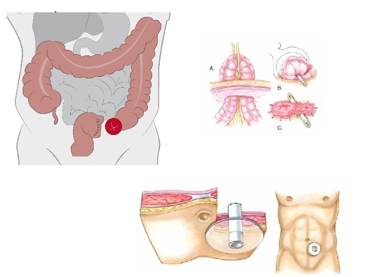 Стома виды. Двуствольная илеостома. Параколостомическая грыжа. Презентация на тему стомы.