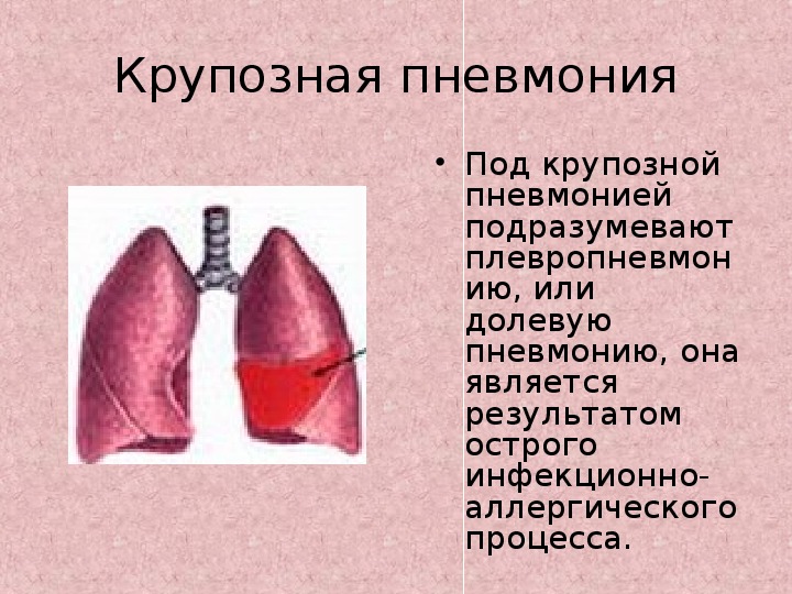 Крупозная пневмония презентация