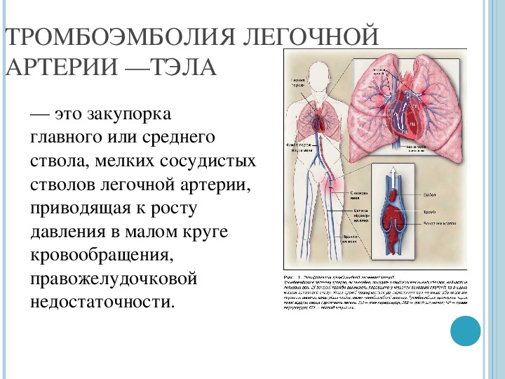 Сердечная недостаточность тромбоэмболия