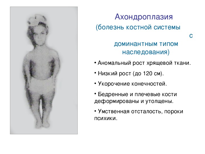 Формы карликовости. Симптомы синдрома ахондроплазия. Ахондроплазия клинические симптомы. Тип наследования симптома ахондроплазия. Ахондропластическая карликовость Тип наследования.